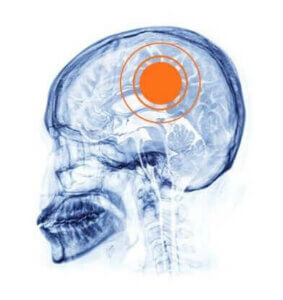 X-ray of a human skull with an orange circle indicating the location of the brain.